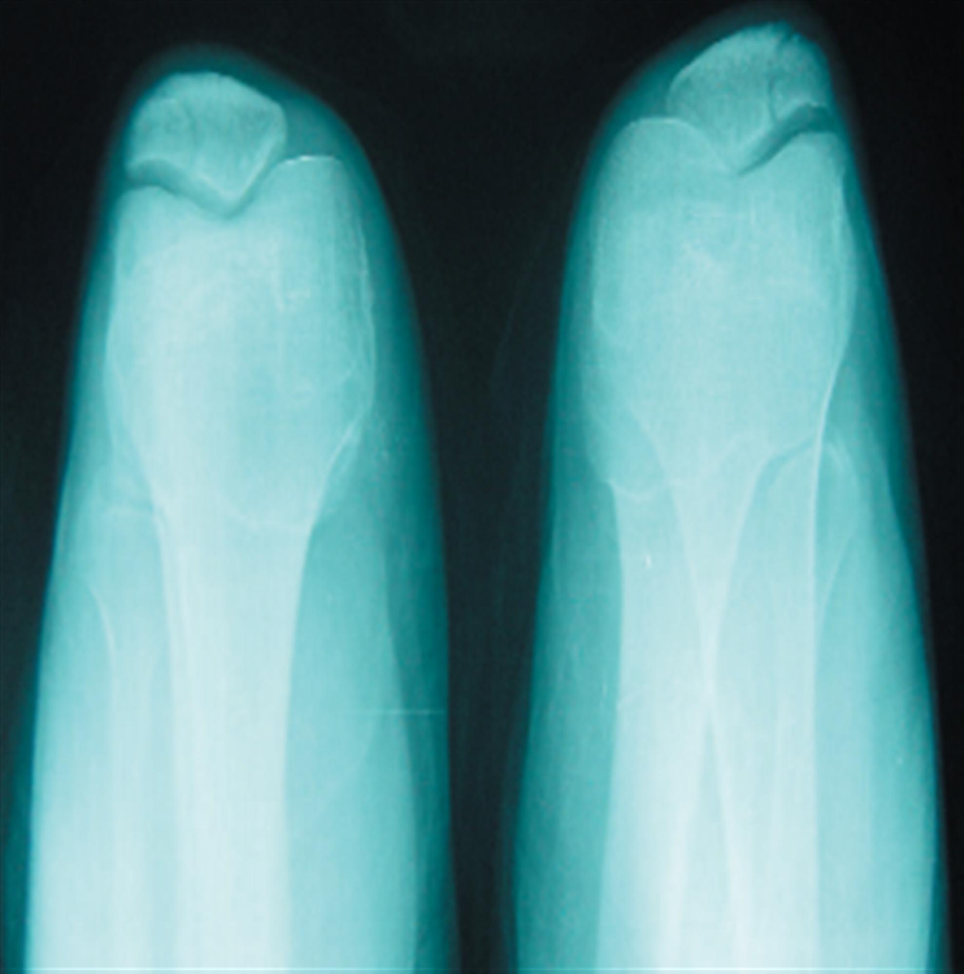 Bipartite Patella Pediatrics Orthobullets